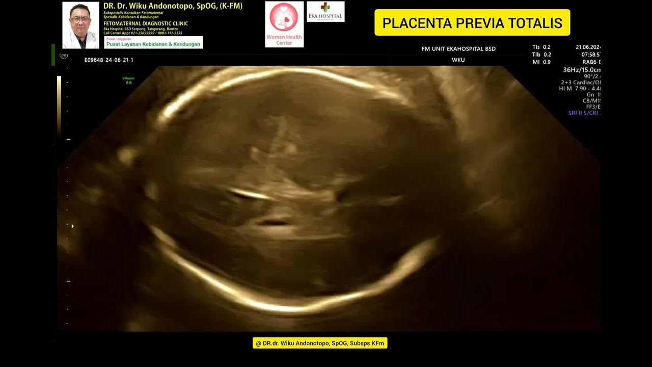 Placenta Previa Totalis YouTube