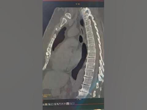 Спондилодисцит - YouTube