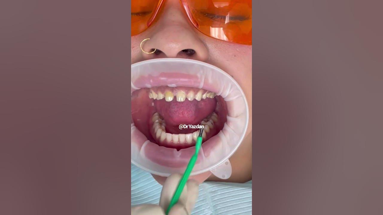 Porcelain veneers procedure dental veneers procedure step by step smile makeover Dr