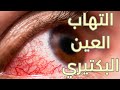 أسباب و علاج التهاب ملتحمة العين البكتيري الرمد الصديدي  