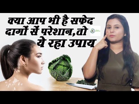 सफेद दाग ( विटिलिगो ) का आसान इलाज – Vitiligo Leucoderma In Hindi || Bhavya Health Care