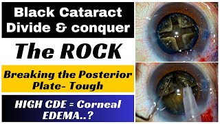 The Black Cataract Phaco - Strategies For The Rock - Dr Deepak Megur