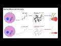 Spinal Muscular Atrophy | Mechanism & Presentation