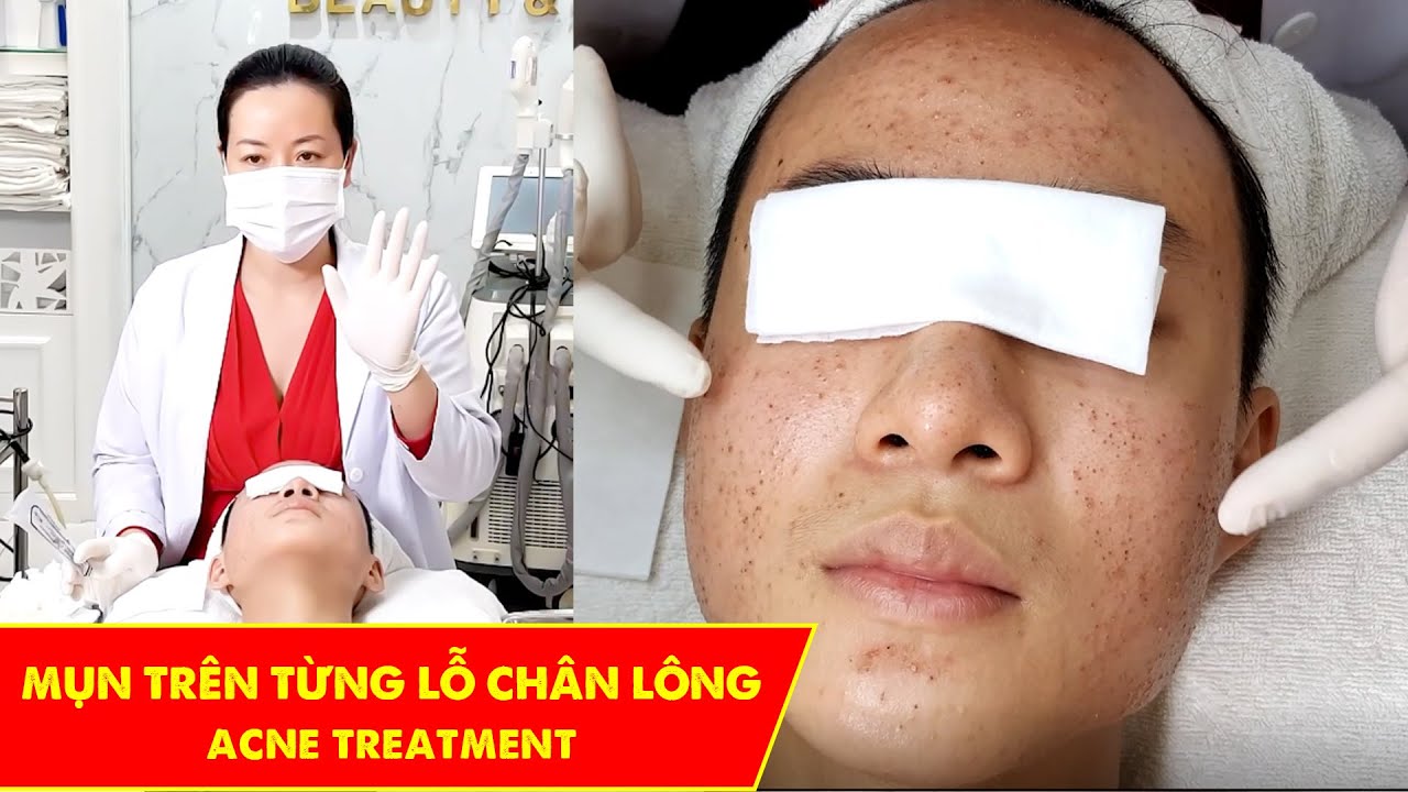 Mụn sau khi tiêm vaccine | Điều trị mụn hiệu quả TPHCM... - youtube