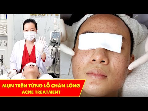Video Mụn sau khi tiêm vaccine | Điều trị mụn hiệu quả TPHCM... - youtube