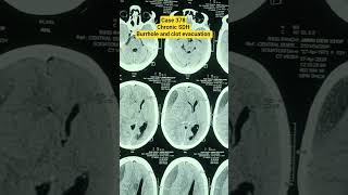 chronic SDH #mch #drsourabhneurosurgeon #rims #neet #ug #pg