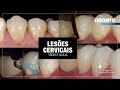 Video Aula: Restaurações Cervicais | Leonardo Muniz