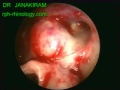 Optic Nerve Decompression Left