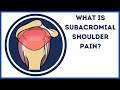 What is subacromial shoulder pain Mp3 Song