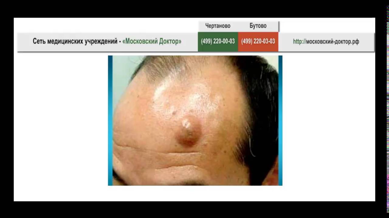 Как выглядит атерома за ухом фото