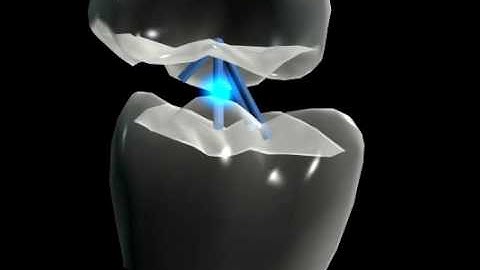 DYNAMIC OCCLUSION - MAXILLA