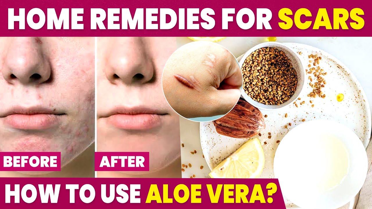 Scar Removal Home Remedies Skin care Tamil Remove Scars YouTube