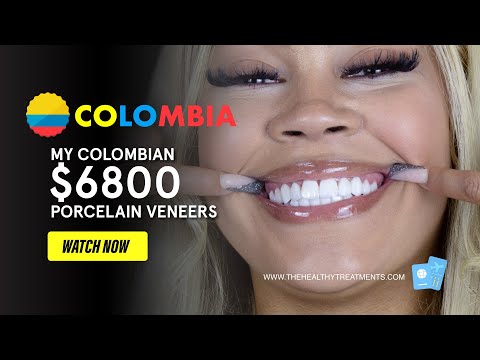 The secret to a better smile — porcelain veneers in Colombia in 4 days