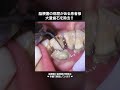 脳梗塞の病歴がある方の歯石除去！口内の健康は全身の健康にも繋がります💪