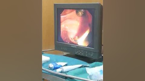 ERCP . Nội soi lấy sỏi ống mật chủ