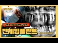 [전체임플란트] 전체 임플란트 과정 | 무치악 | 틀니 | 후기 | 연세힐치과