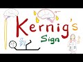Kernig Sign | Meningitis | Neurology Physical Exam