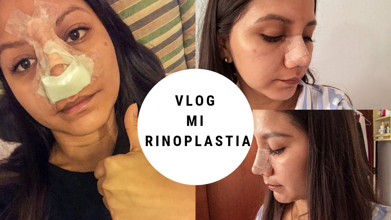 Cómo aliviar la congestión después de la rinoplastia Cómo aliviar la congestión después de la rinoplastia