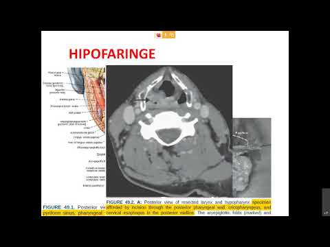 Vídeo: El càncer d'hipofaringe es cura?