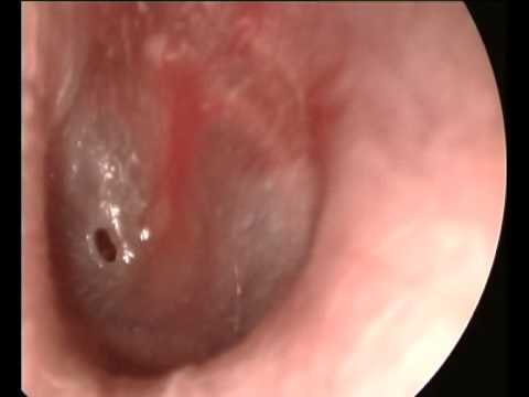 A perforated eardrum