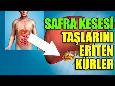 Video: Ameliyatsız safra taşlarından nasıl kurtulurum