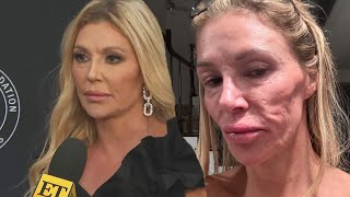 Brandi Glanville Questions If Parasite Is to Blame for Disfigured Face