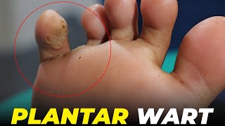 The ultimate guide to painless plantar wart removal | Plantar Wart Remove | Wart Removel #viral