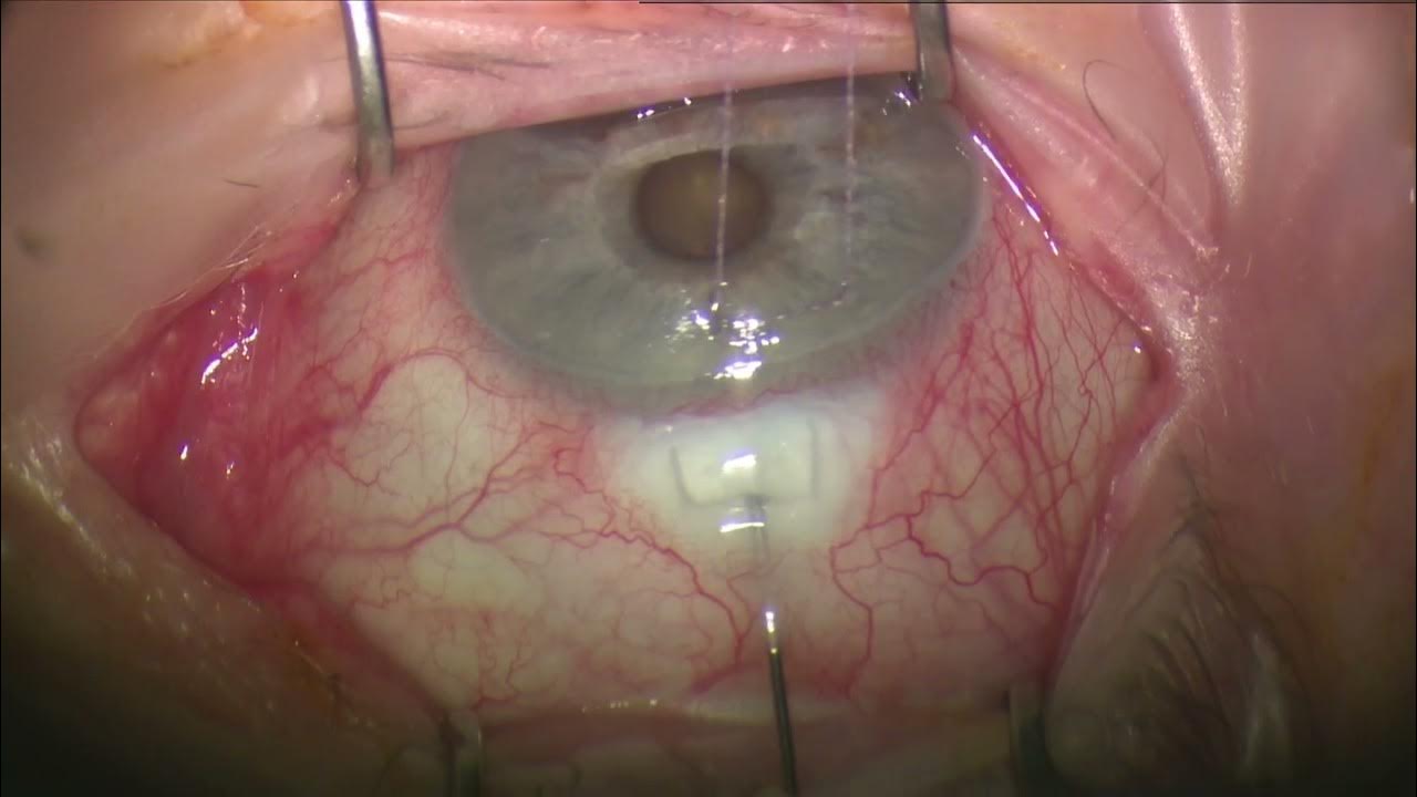 Trabeculectomy/Bleb Revision Technique YouTube