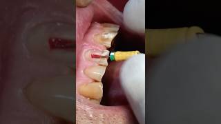 root canal treatment steps #rct #rootcanaltreatment #dental #endodontics #toothcrown #toothtreatment