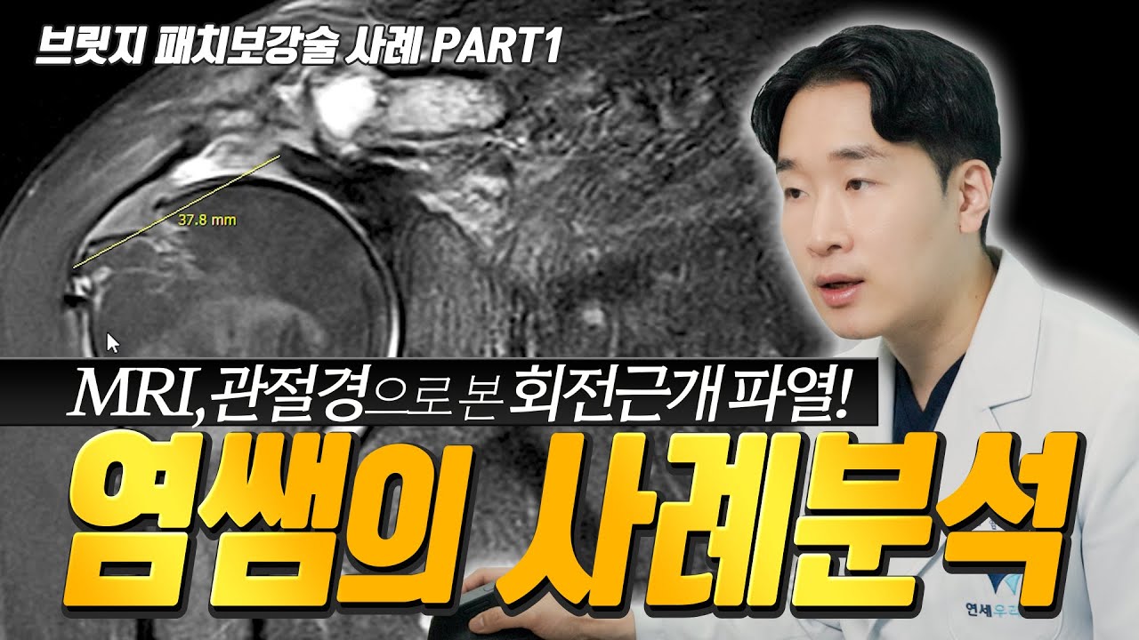 회전근개 파열!! - 브릿지 패치보강술 사례분석 하기 PART 1편 #회전근개 #회전근개수술 #어깨통증 - YouTube