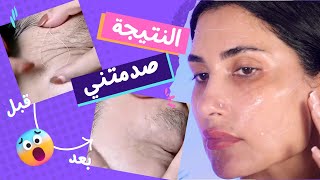 شد البشرة من غير عملية و لا ابر مع خيوط الكولاجين و البروتين | النتيجة صدمتني