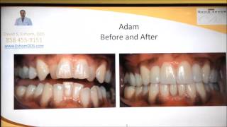 Instant Orthodontics With Porcelain Veneers In San Diego