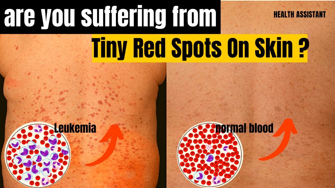 Symptoms Of Leukemia Leukemia Tiny Red Spots On Skin Chronic