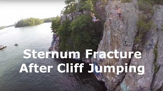 Manubrium Sternum Fracture After Cliff Jumping