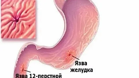 Язвенная болезнь желудка и 12-перстной кишки. Причины, симптомы, стадии и сроки рубцевания язвы