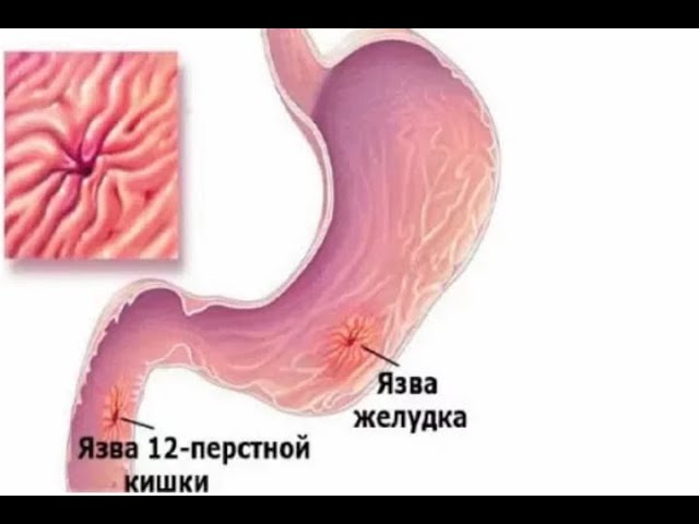Язвенная болезнь желудка и 12-перстной кишки. Причины, симптомы, стадии и сроки рубцевания язвы