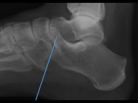 talocalcaneal coalition mri