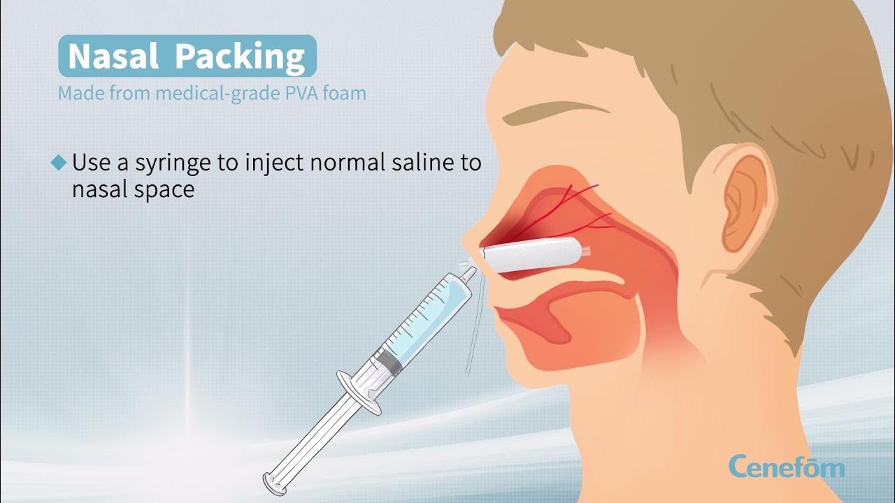Cenefom Nasal Packing YouTube