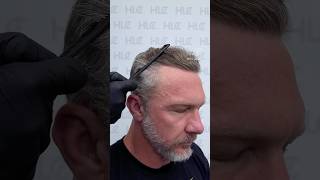 hairline restoration with 3524 Grafts by HLC, before, post op, 12 months results.  #hairstyle