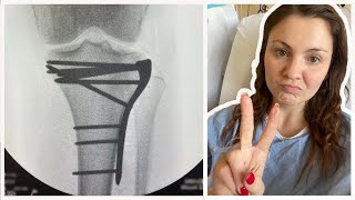 My Surgery Story & Scar Reveal - Broken Knee