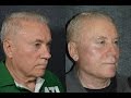 Facelift for Men Before and After | Male Plastic Surgery with Dr Jacono #faceliftfor men