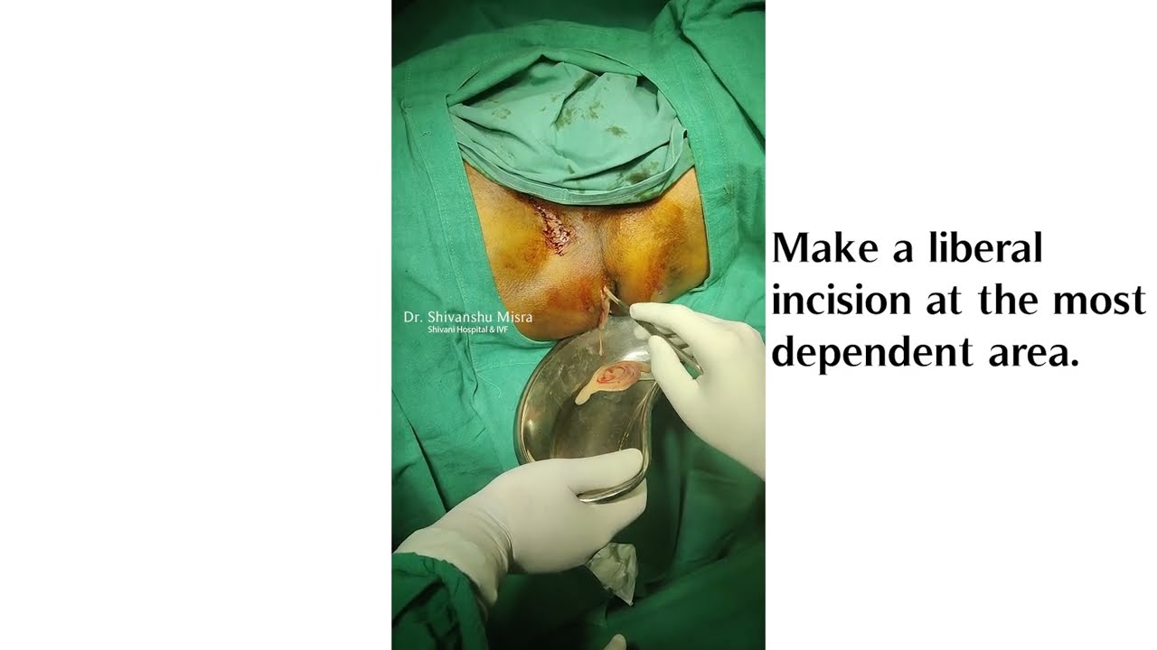 PERIANAL ABSCESS (INCISION AND DRAINAGE) - YouTube