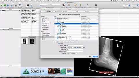 How to import DICOM and JPEGs into OsiriX Lite