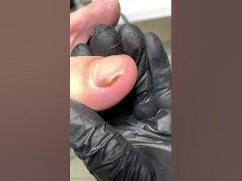Вростающий ноготь это боль!!! - YouTube