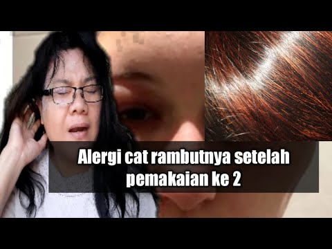 Alergi Parah setelah warnai rambut ke 2 kali|Alergi Cat Rambut