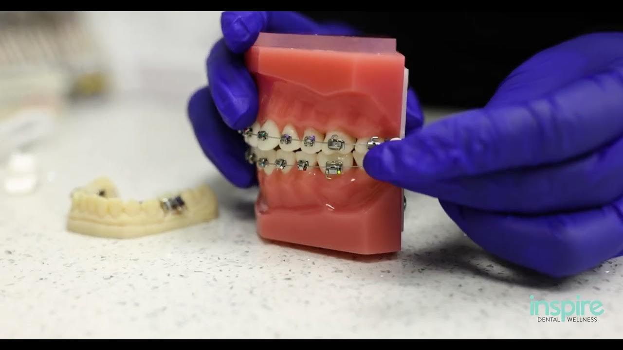 How to apply Gishy Goo for braces YouTube