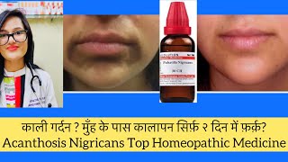 काली गर्दन? काले होंट? को गोरा करे?Dark Neck Home Remedy ? Acanthosis Nigricans Homeopathy Medicine