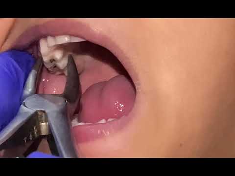 خلع ضرس للمبتدئين