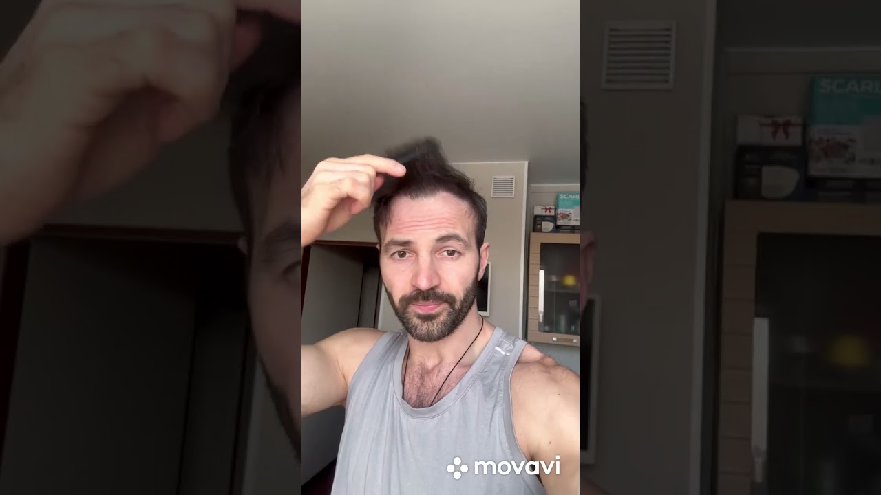 Вторая пересадка волос. 3 года спустя.