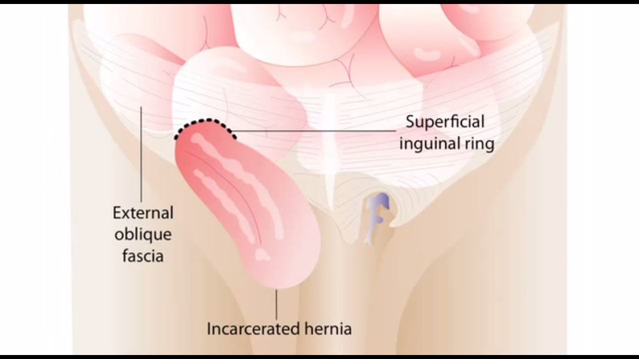 Right Inguinal Hernia Repair (Male Patient) 